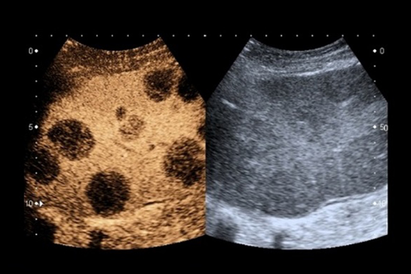 Liver Contrast-Enhanced Ultrasound