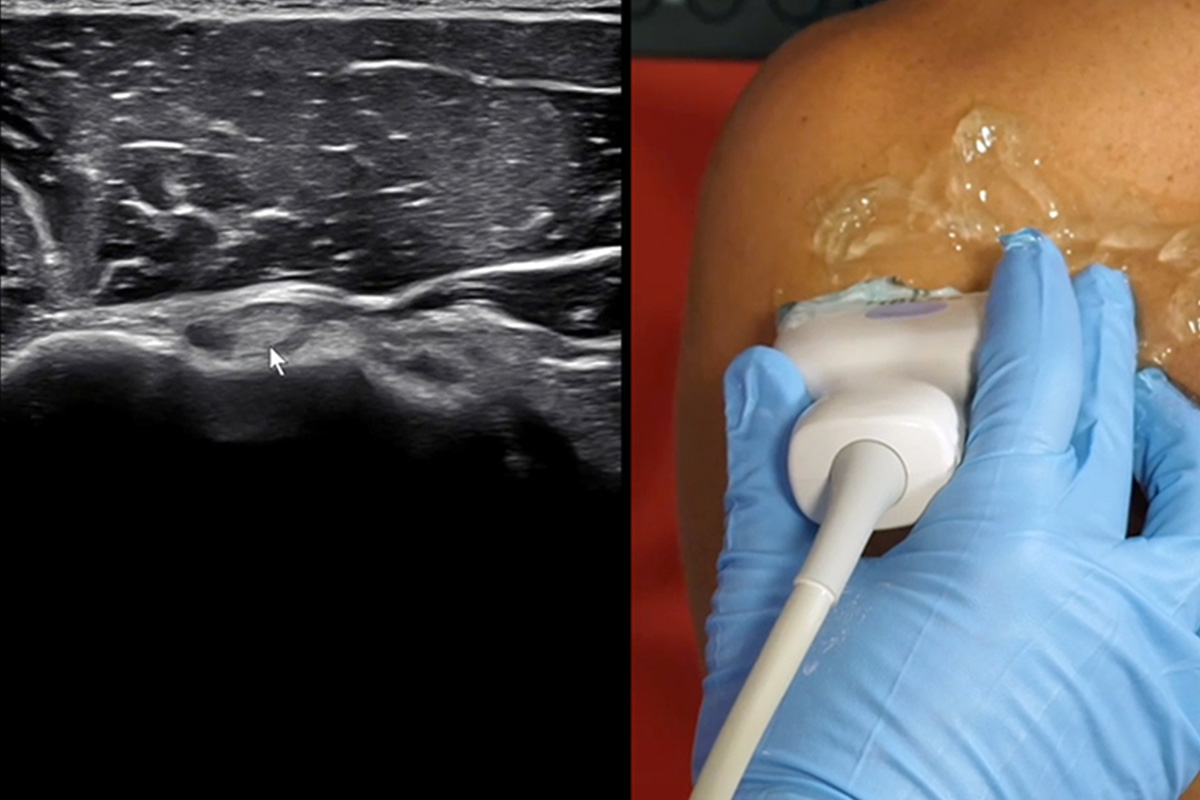 MSK of the Shoulder and Beyond