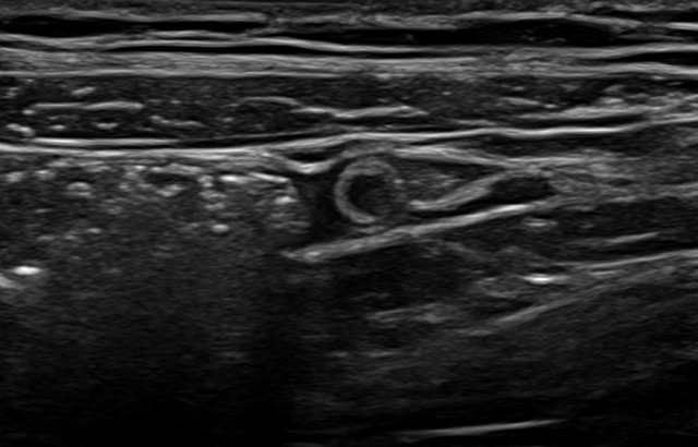 Sonography of the Appendix
