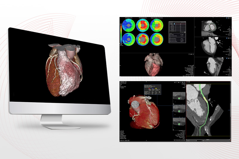 Vitrea CT Cardiac