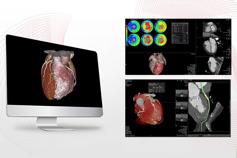 Vitrea CT Cardiac