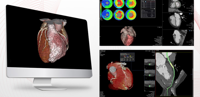 Vitrea CT Cardiac